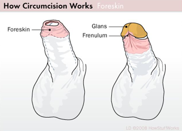 What does a circumsised penis look like - Porn galleries
